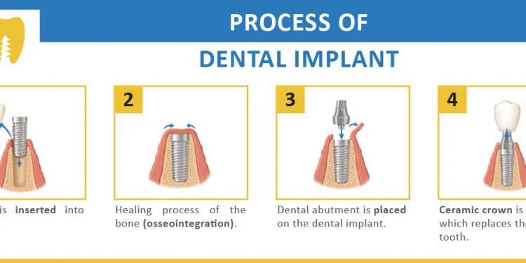 Dental Implants Thailand