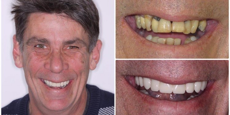 Dental Implant Toronto Is a