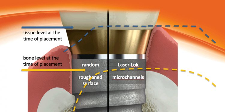 Laser-Lok microchannels is a