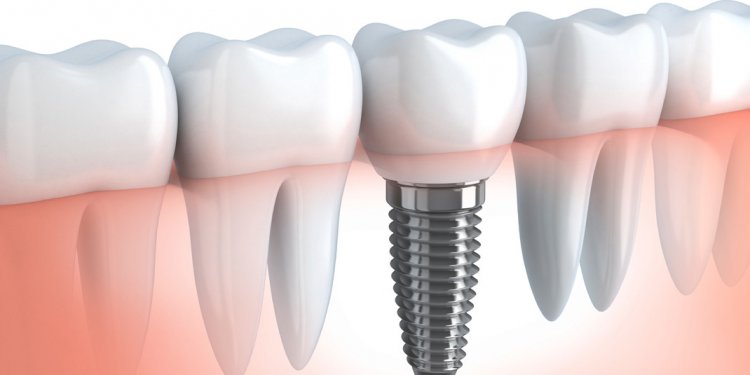 Dental Implants