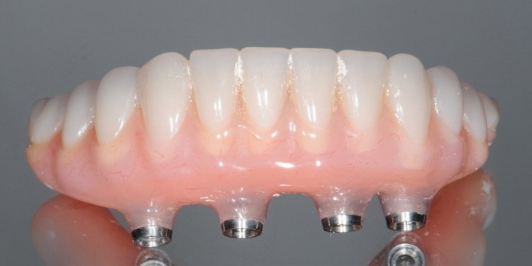 All On Four Implants Dental