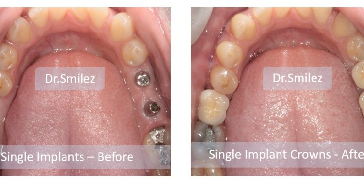 Implants before-after