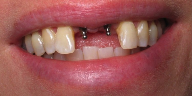 The Dental Implant Placement