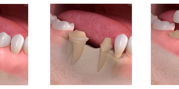 ADVANTAGES OF DENTAL IMPLANTS