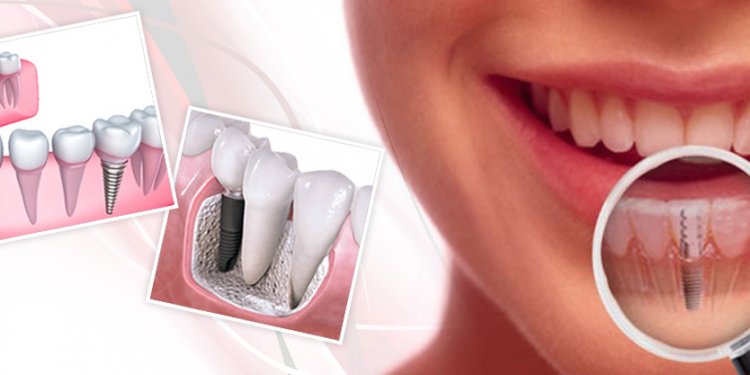 Dental Implants / Dental