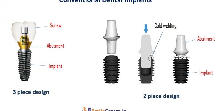 Conventional implant design