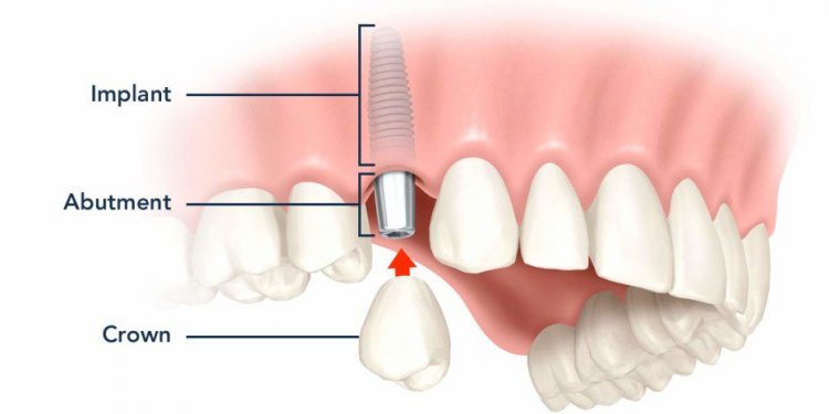 Parts of a dental implant