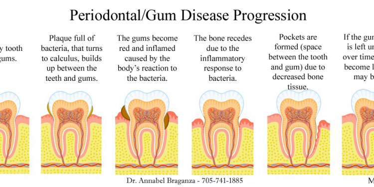 Gum Disease, Gum Disease