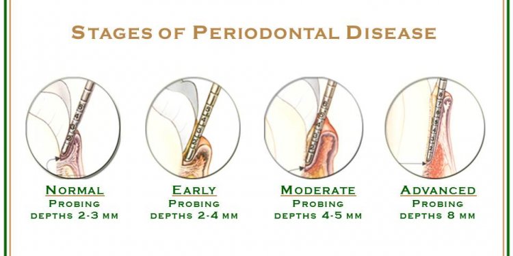 The word periodontal means