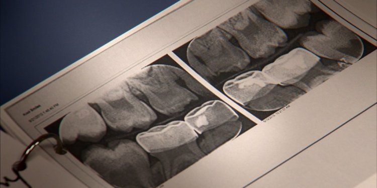 How To Fix A Broken Dental