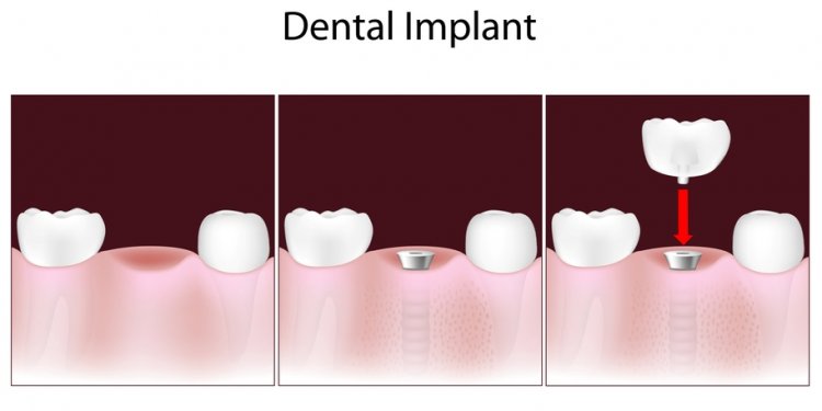 Dental implants. blood