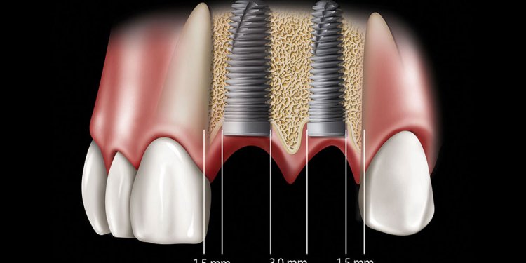 Two adjacent implants