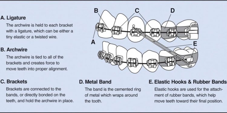 Invisalign Invisible Braces