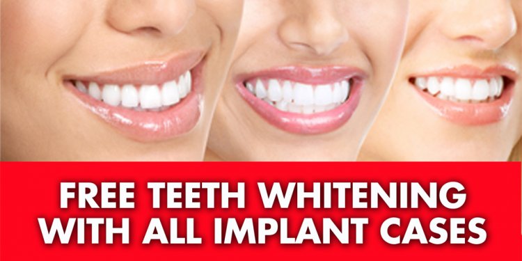 Dental-Implants-of-LI-Free