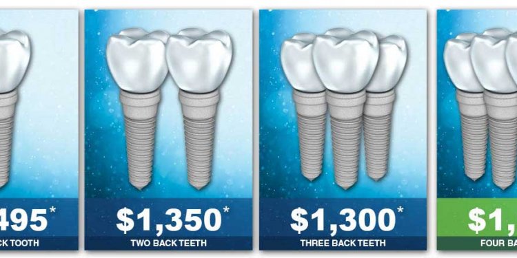 Dental Implants Cost