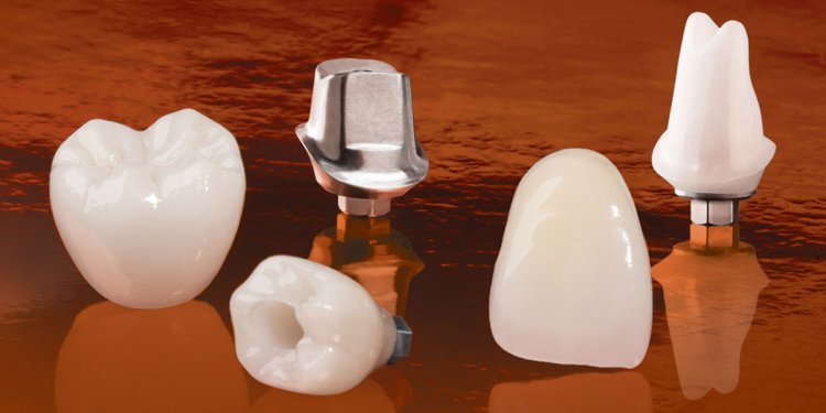 Restorations Over Implants