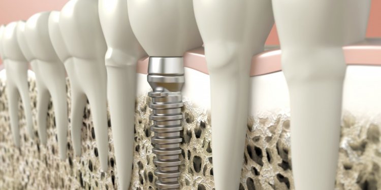 Dental Implants