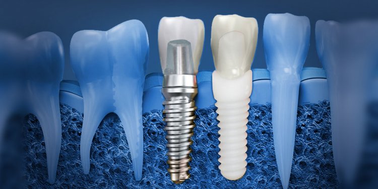 Dental Implant Materials