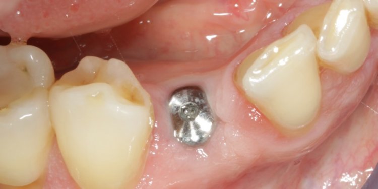 Dental implant is left for 3-4