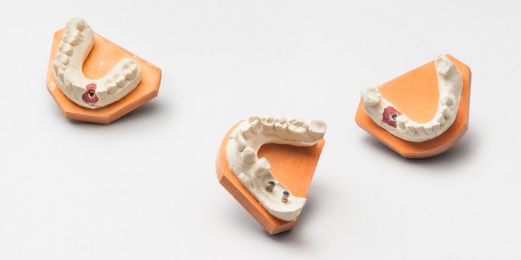 Dental Implants USA
