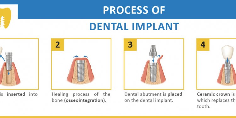 Process of getting Dental Implants