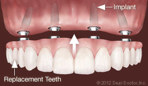 All on 4 replacement teeth.