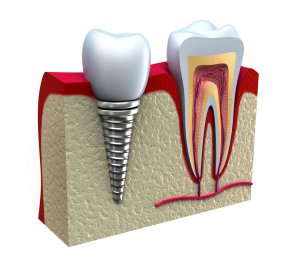 APEX Implants