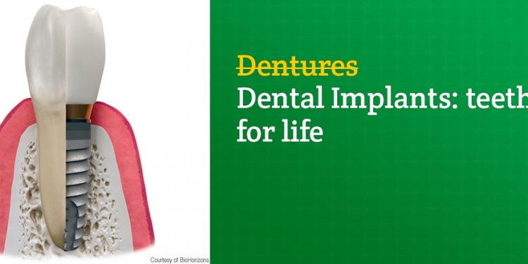 Benefits of Dental Implants