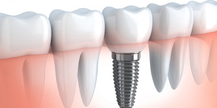Does any insurance cover dental implants
