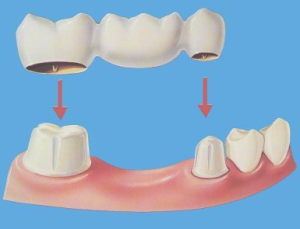 Dental Bridge