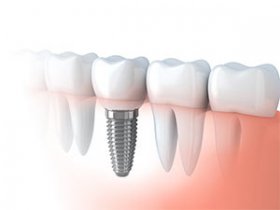 Dental Implant