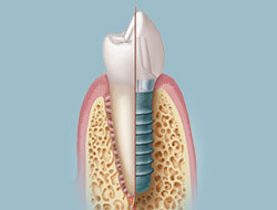 Dental Implant Illustration