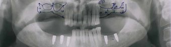 dental implant problems showed by x-rays