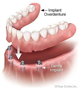 Dental Implants