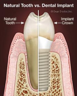 Dental Implants