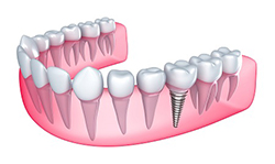 Dental implants and full mouth reconstruction from the leading dental implant specialist in Kennewick, WA