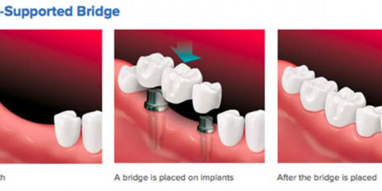 Dental Implants California