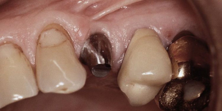 Are Dental Implants dangerous