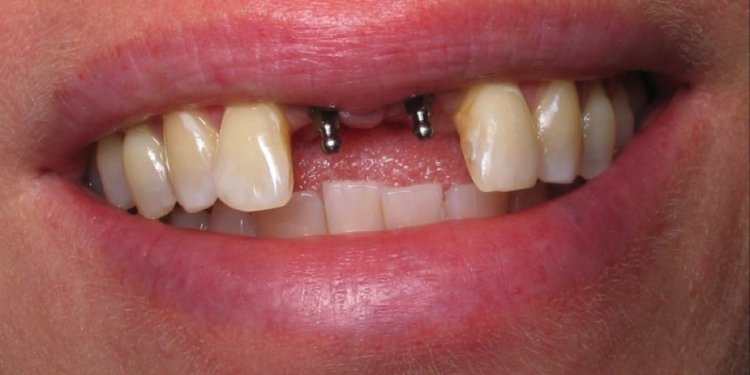 Dental Implant Placement Procedure