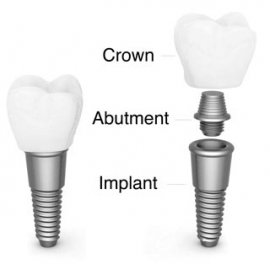 Dental implants elements