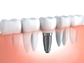 dental implants northridge ca