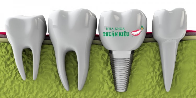 Dental Implants Options
