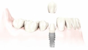 dental-implants-procedures.png