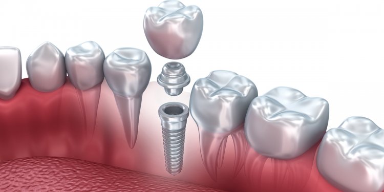 Dental Implants Procedures