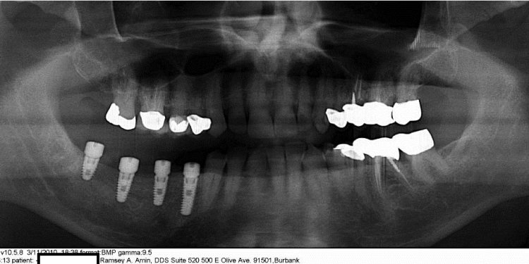 Does insurance cover dental implants