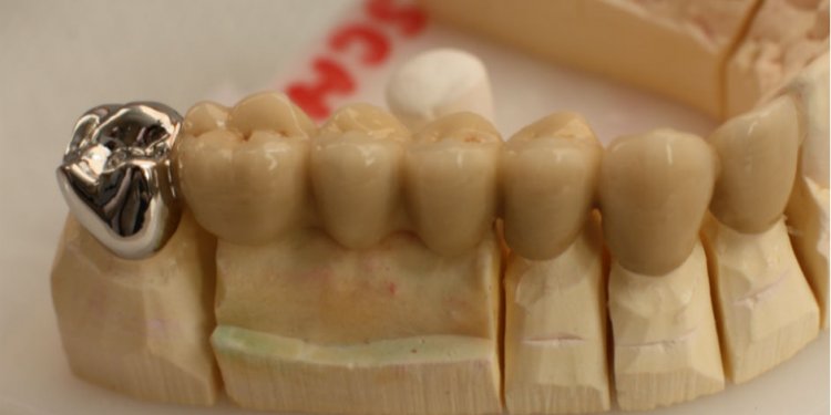 Dangers of Dental Implants
