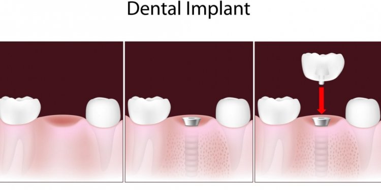 Tooth Implants covered by insurance