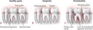 Gum disease develops when inflammation spreads to the tissues that support the teeth. Healthy gums (A) are firm and tightly hug the teeth. Without proper cleaning, plaque can build up where the gum tissue meets the tooth. As plaque accumulates, the gum tissue pulls away from the tooth, creating a tiny pocket. The gums become inflamed, a condition called gingivitis (B). Gingivitis can get worse, causing a more severe gum disease known as periodontitis (C). Here, the pocket widens as the gum pulls back from the root of the tooth. The disease also destroys the periodontal ligament and bone, reaching the tooth socket. Depending on the level of severity, the ligament and bone damage can cause the tooth to become loose, and it may fall out.