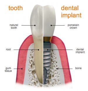 How long does the dental impant process take is determined by several factors