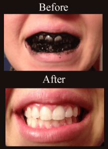 how to whiten teeth naturally with charcoal